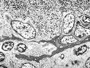 F, 72y. | carcinoid … metastasis to lymphonode F, 72y. | carcinoid … metastasis to lymphonode